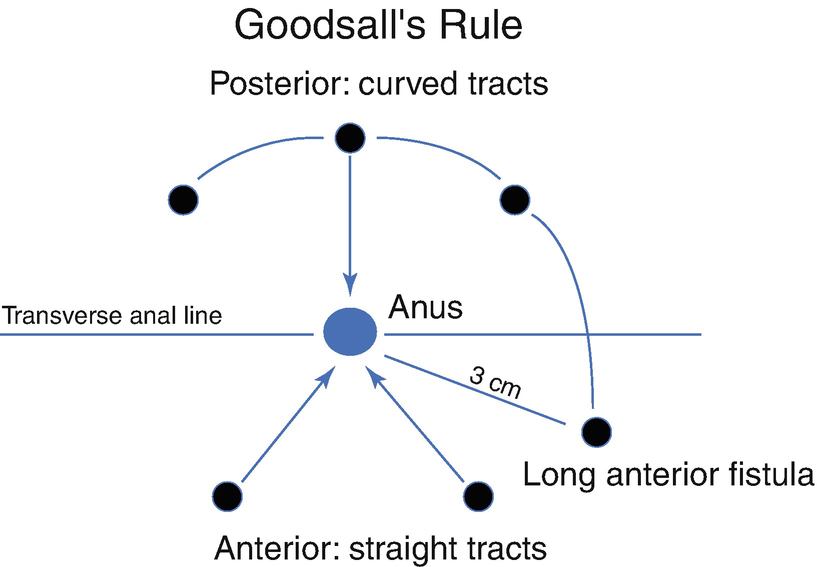 Goodsall's rule